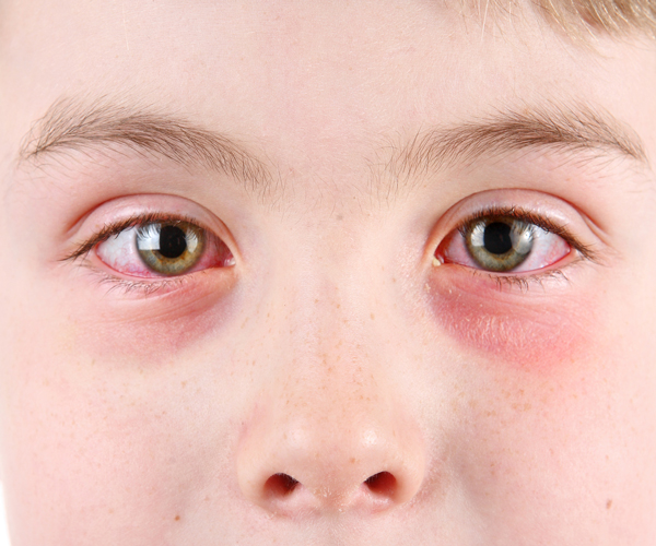 Conjunctivitis (Pink Eye)